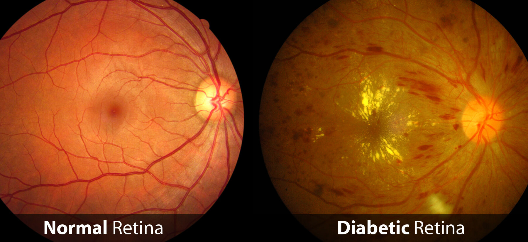 Diabetic eye disease treatment at Ulwe Eye Clinic Navi Mumbai